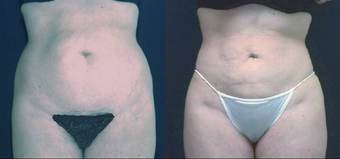 Liposculpture before 657920