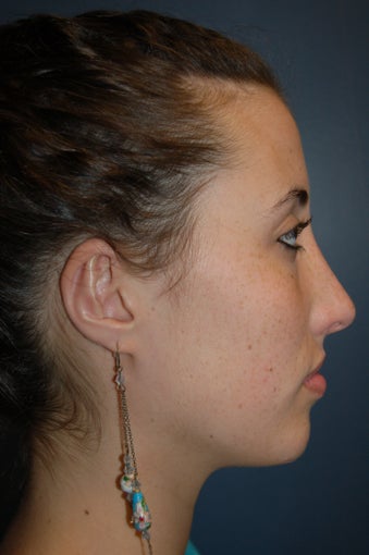 Nose Surgery after 928661