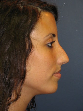 Nose Surgery before 928661