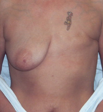 Breast Reconstruction before 78399