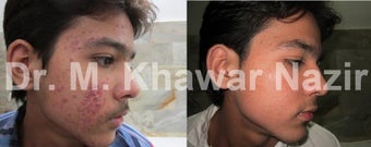 Acne Treatment before 1123336