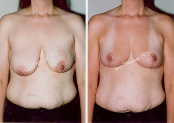 Mastopexy-Breast Lift before 243709