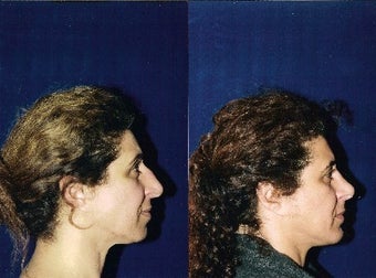 Rhinoplasty and Septoplasty before 223642