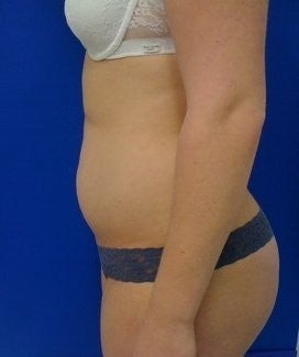 Laser Lipo 333242