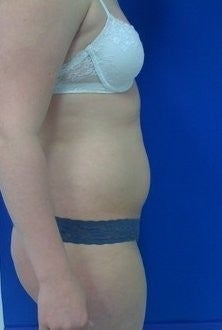 Laser Lipo before 333242