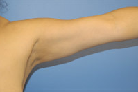 Arm Liposuction after 652126