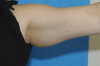 Arm Liposuction before 652126