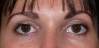 Botox Used To Treat Eye Wrinkles and Change Eye Shape after 1367249
