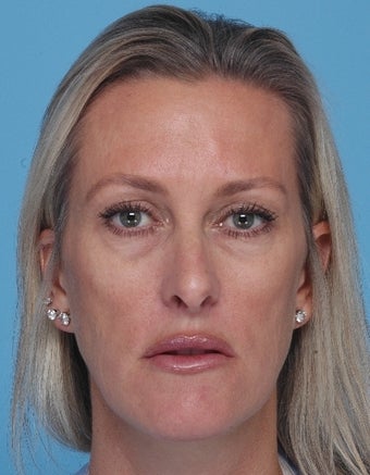 Juvederm injections to tear troughs and cheeks before 67260
