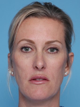 Juvederm injections to tear troughs and cheeks after 67260