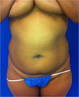 Laser Liposuction 561227