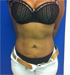 Laser Liposuction 561227