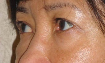 Restylane before 959481