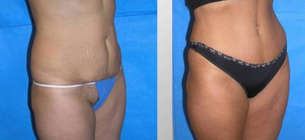 Tummy Tuck (Abdominoplasty) before 258037