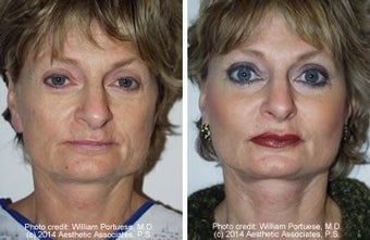 Cheek and Chin Implants, Neck Lift before 6777
