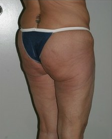 Thigh and Buttock Lift 99887