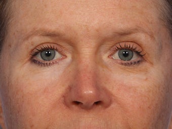 Eyelid Surgery after 280834