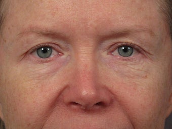 Eyelid Surgery before 280834