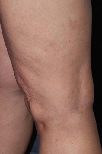 62 year old female treated with Sclerotherapy for Leg Veins after 986684