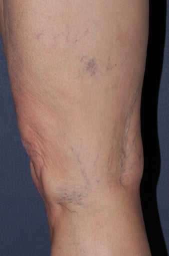 62 year old female treated with Sclerotherapy for Leg Veins before 986684