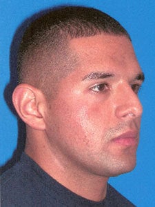 Otoplasty Ear Surgery - Male 818055