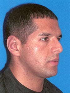 Otoplasty Ear Surgery - Male 818055