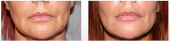 Restylane Treatment in the Lips before 949257