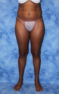 Brazilian Butt Lift and creating curves before 671107