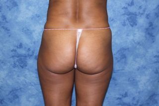 Brazilian Butt Lift and creating curves 671107