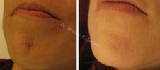 Starlux 1540 for Scar removal and skin plumping before 75749