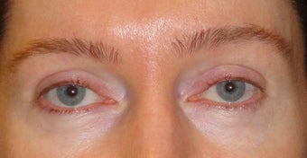 Botox before 967782