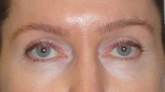 Botox after 967782