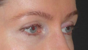 Botox 967782