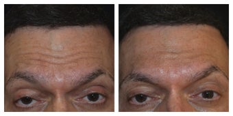 50 Year Old Male Treated for Forhead Lines before 1373418