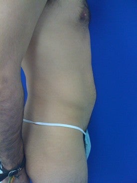 Laser Lipo 333244