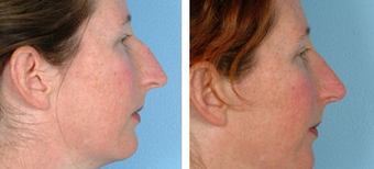Functional Rhinoplasty before 1208314