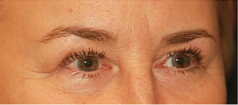 Eye Bag Surgery 887169