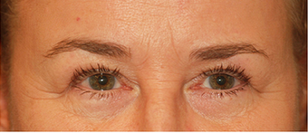 Eye Bag Surgery before 887169
