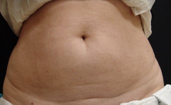 Coolsculpting before 495016