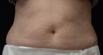 Coolsculpting after 495016