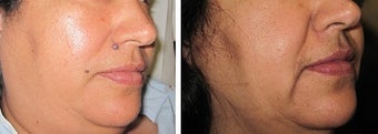 Mole Removal photos before 951878