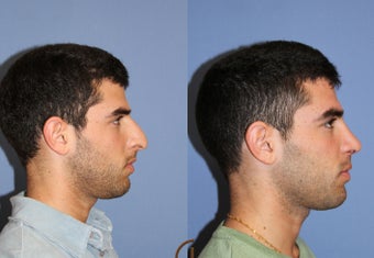 primary male rhinoplasty before 450434