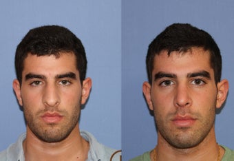 primary male rhinoplasty after 450434