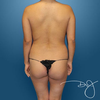 Butt Augmentation before 864869