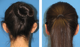Ear Surgery Before After after 1088404
