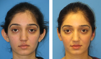 Ear Surgery Before After before 1088404