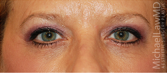 Eye Bag Surgery after 886789