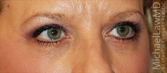 Eye Bag Surgery 886789