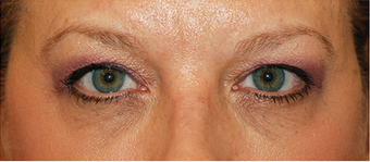 Eye Bag Surgery before 886789