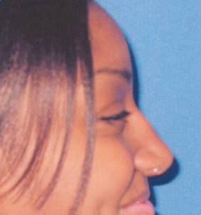 Ethnic Rhinoplasty 529786